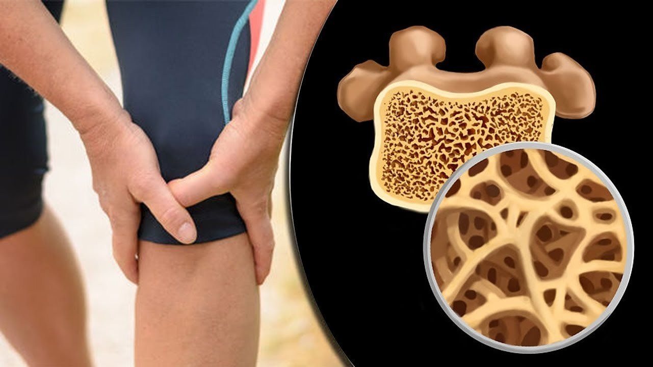 هشاشة العظام 