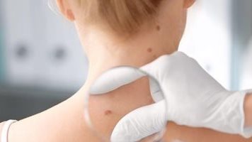 سرطان الجلد 