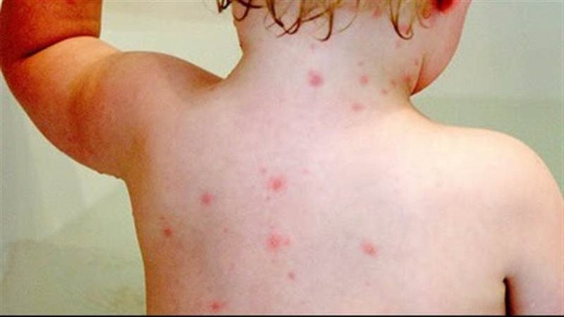 الجديري المائي