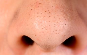 البثور السوداء