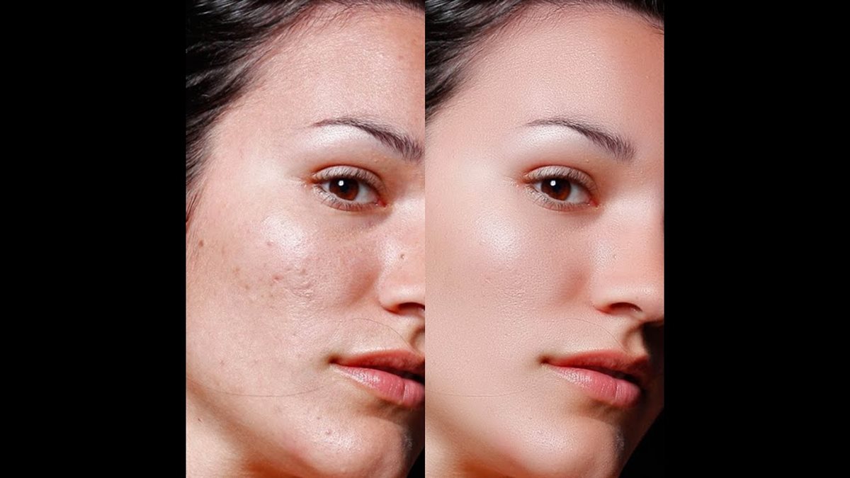 التخلص من البثور البيضاء