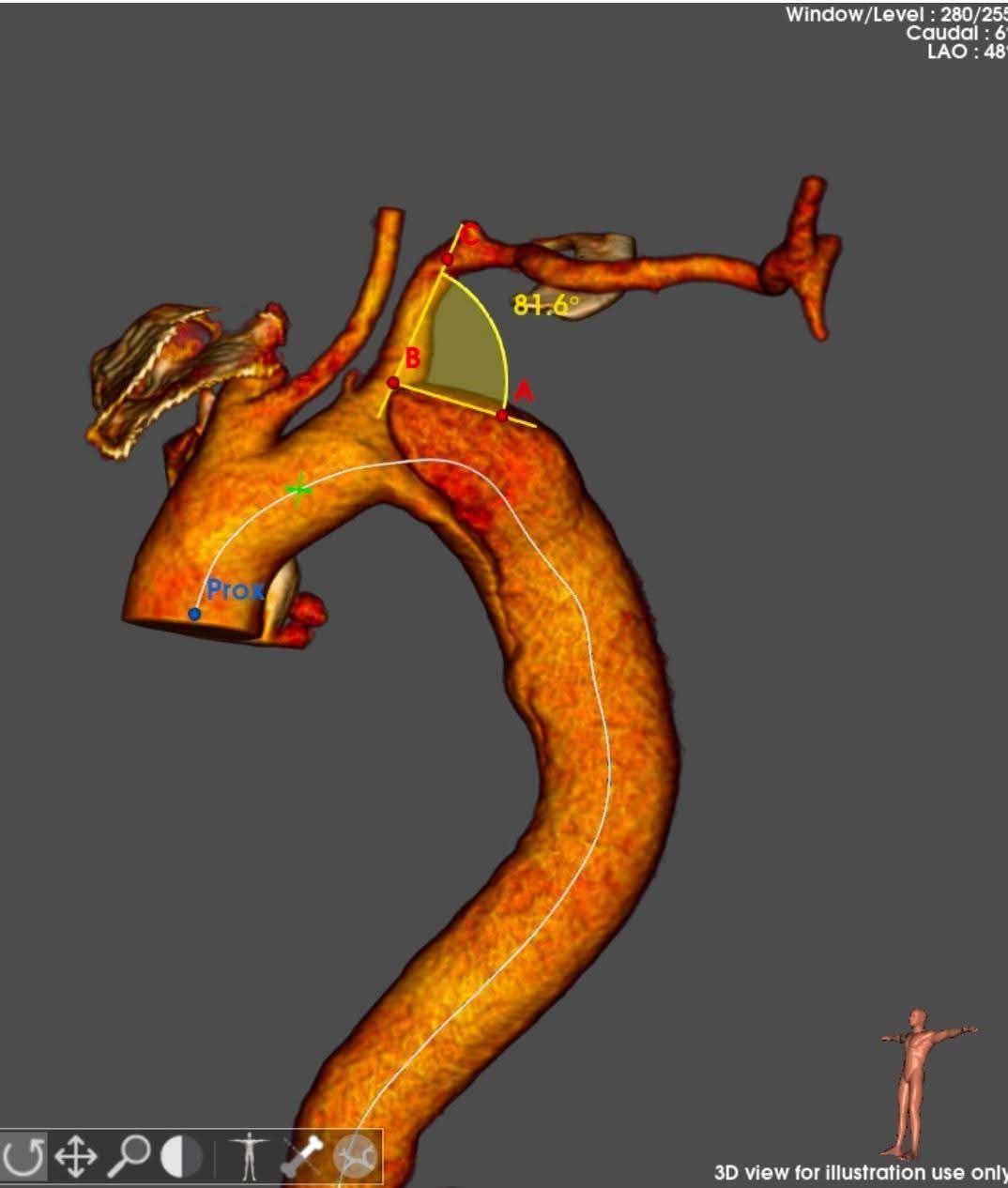 مستشفي مصر للطيران تجري عملية اصلاح إنشطار بالشريان الأورطي الصدري