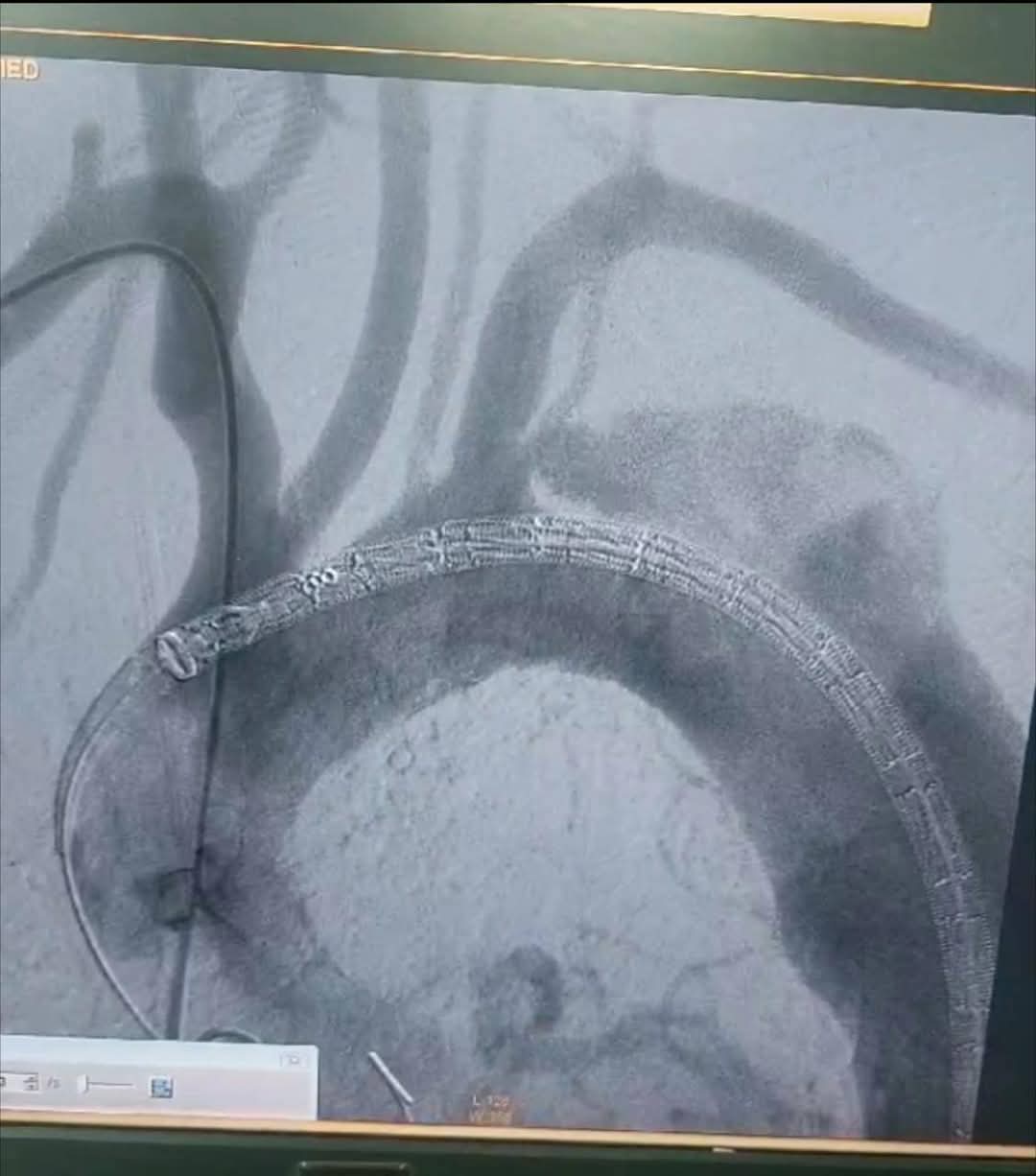 مستشفي مصر للطيران تجري عملية اصلاح إنشطار بالشريان الأورطي الصدري