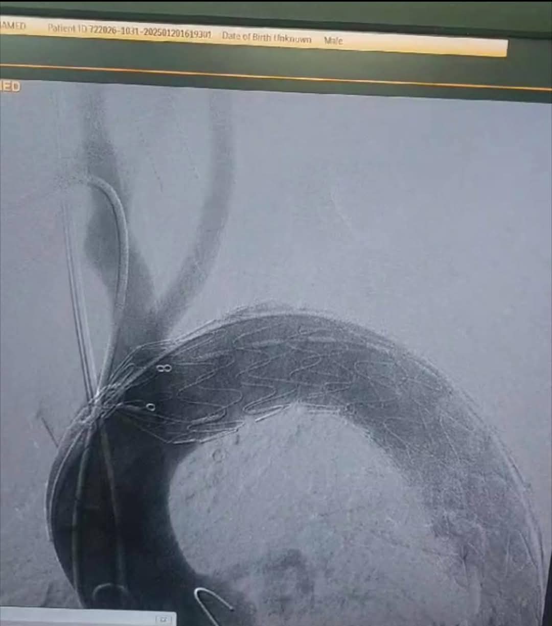 مستشفي مصر للطيران تجري عملية اصلاح إنشطار بالشريان الأورطي الصدري