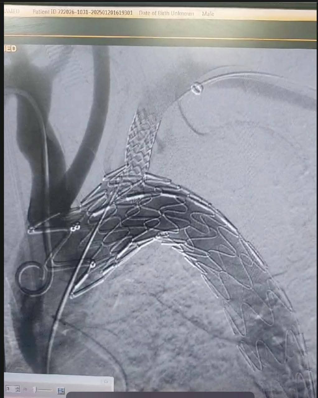 مستشفي مصر للطيران تجري عملية اصلاح إنشطار بالشريان الأورطي الصدري