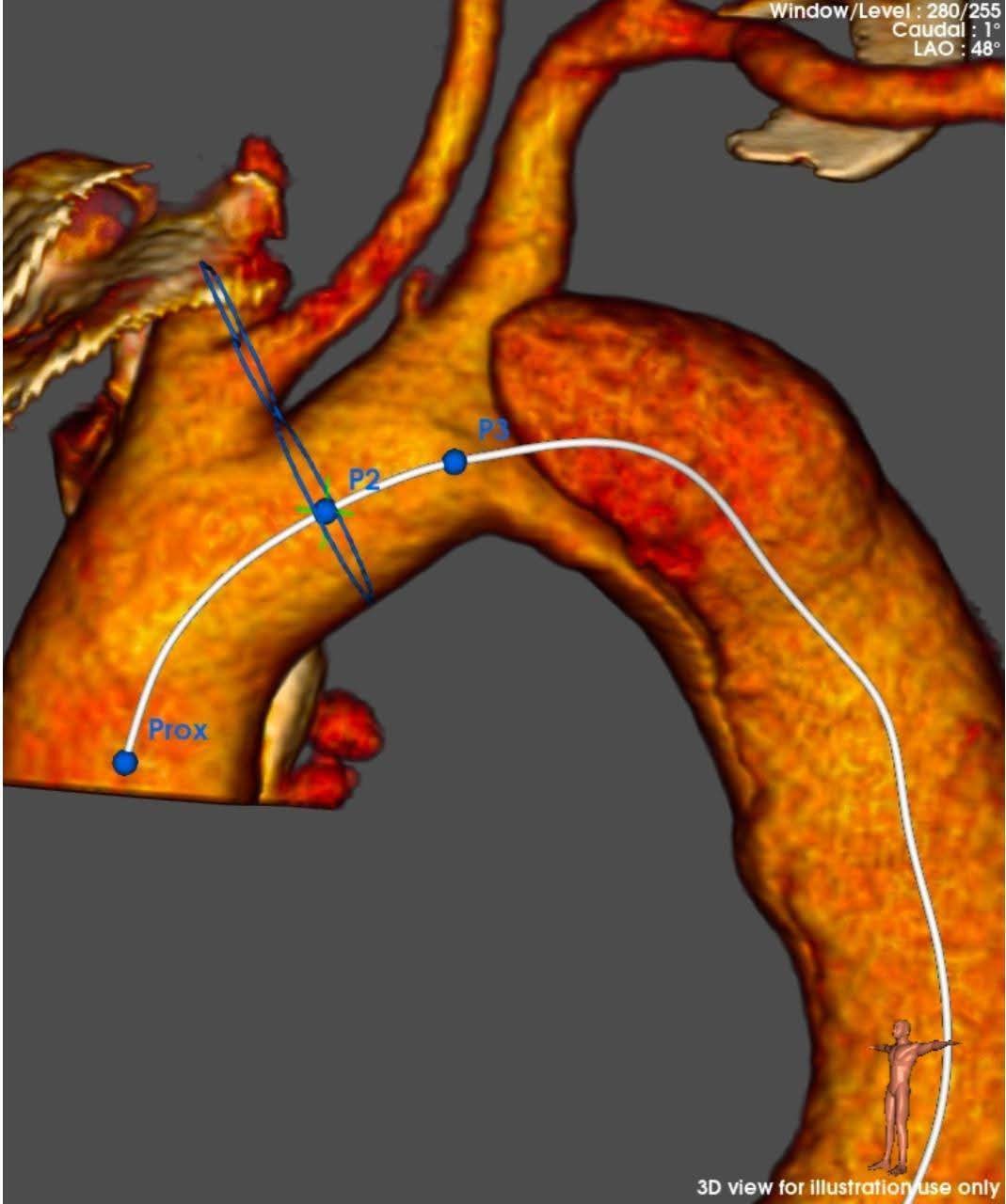 مستشفي مصر للطيران تجري عملية اصلاح إنشطار بالشريان الأورطي الصدري