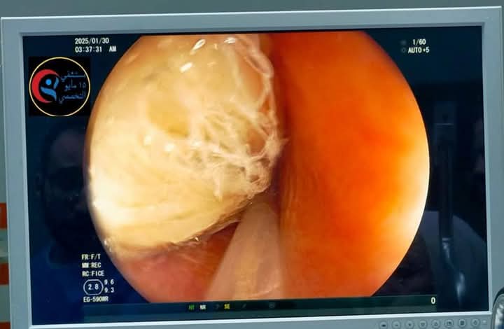 منظار المريء