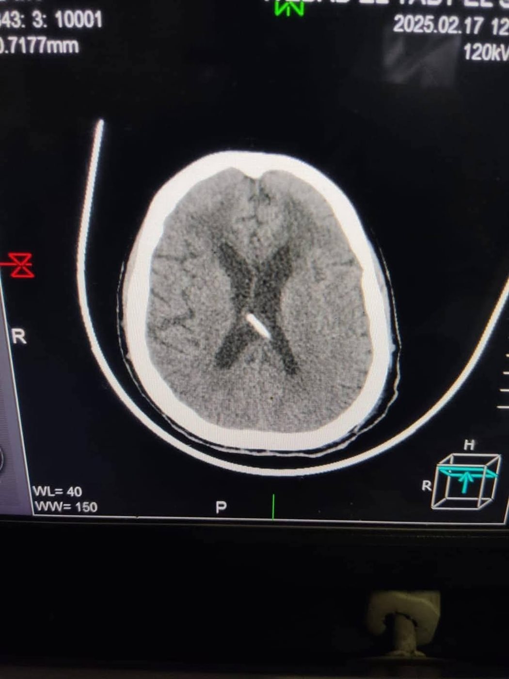 جراحة ناجحة لتركيب صمام مخى بريتونى