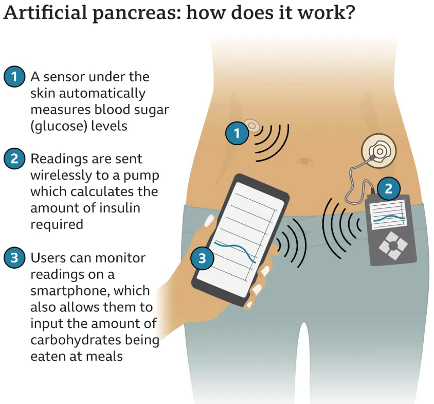 أحدث علاج لمرض السكر، فيتو