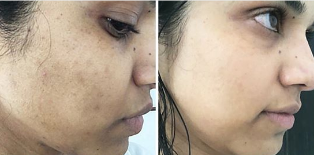 إزالة البقع من البشرة