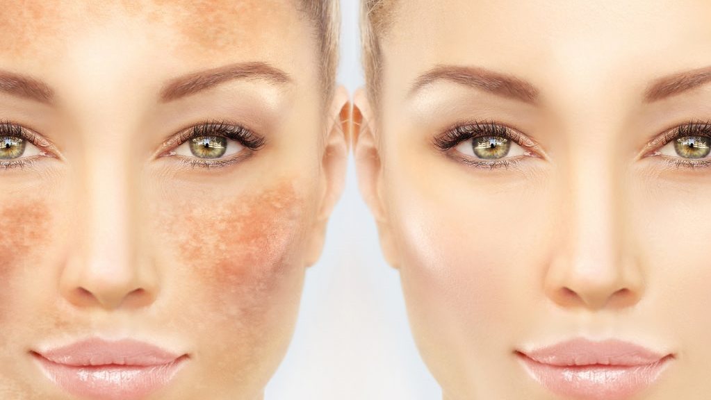 إزالة تصبغات البشرة