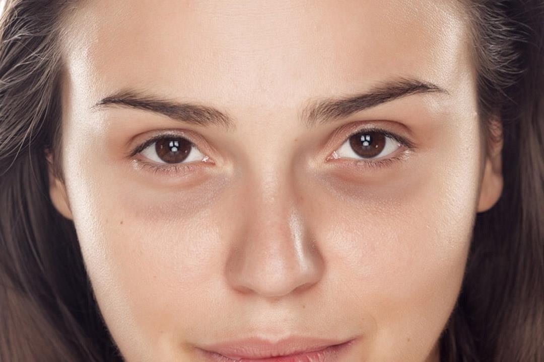 الهالات السوداء 