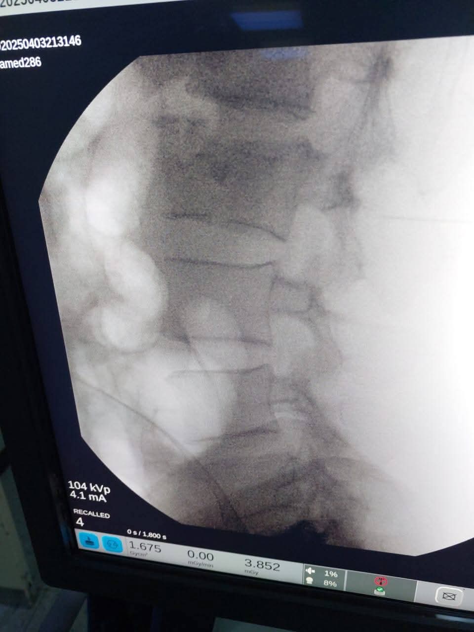 أول جراحة للعمود الفقري في مستشفى كفر سعد المركزي بدمياط