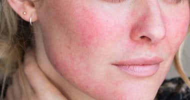 قناع طبيعي يخلصك من الالتهابات بالبشرة