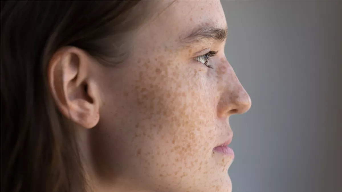 قناع طبيعي يخلصك من النمش