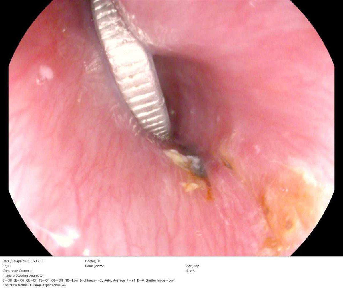 تفعيل وحدة مناظيرالأطفال وإنقاذ طفل بعد ابتلاعه لعملة معدنية بالشرقية،فيتو3