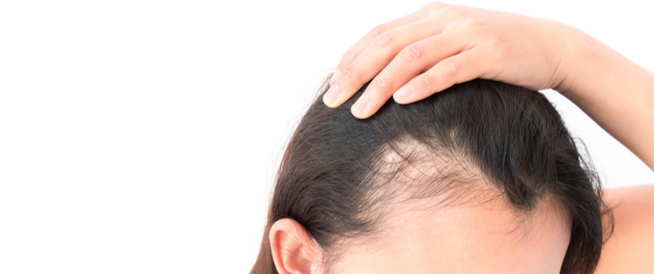 علاج الصلع عند النساء 