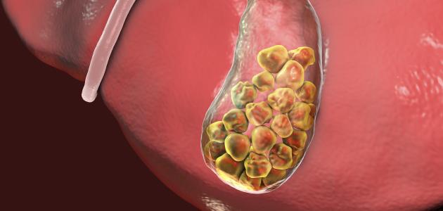 أعراض حصوات الكلى