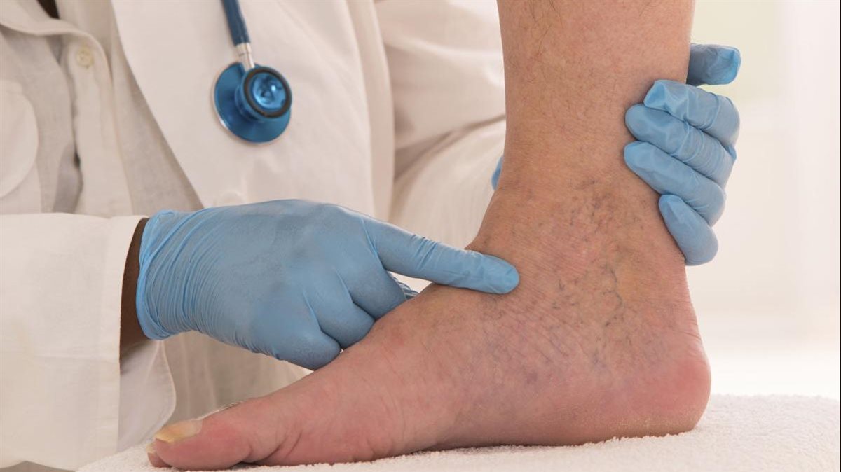 دوالي الساقين وأعراضها