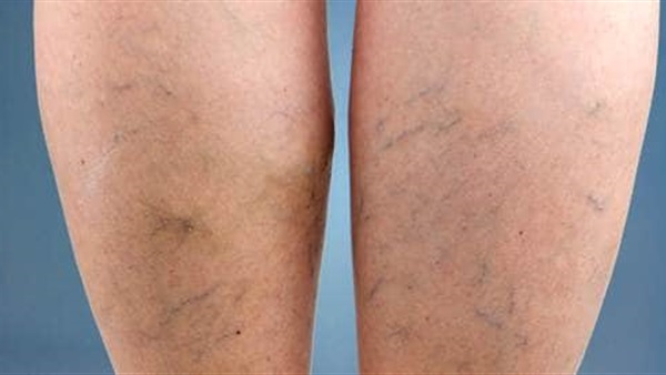 دوالي الساقين وعلاجها