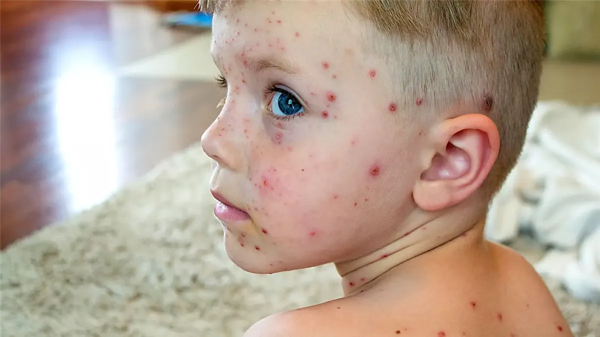 الفرق بين حساسية الصيف والجديري المائى