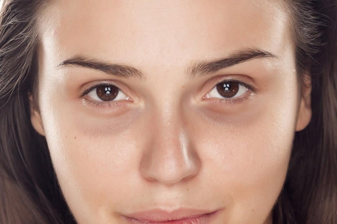 التخلص من الهالات السوداء