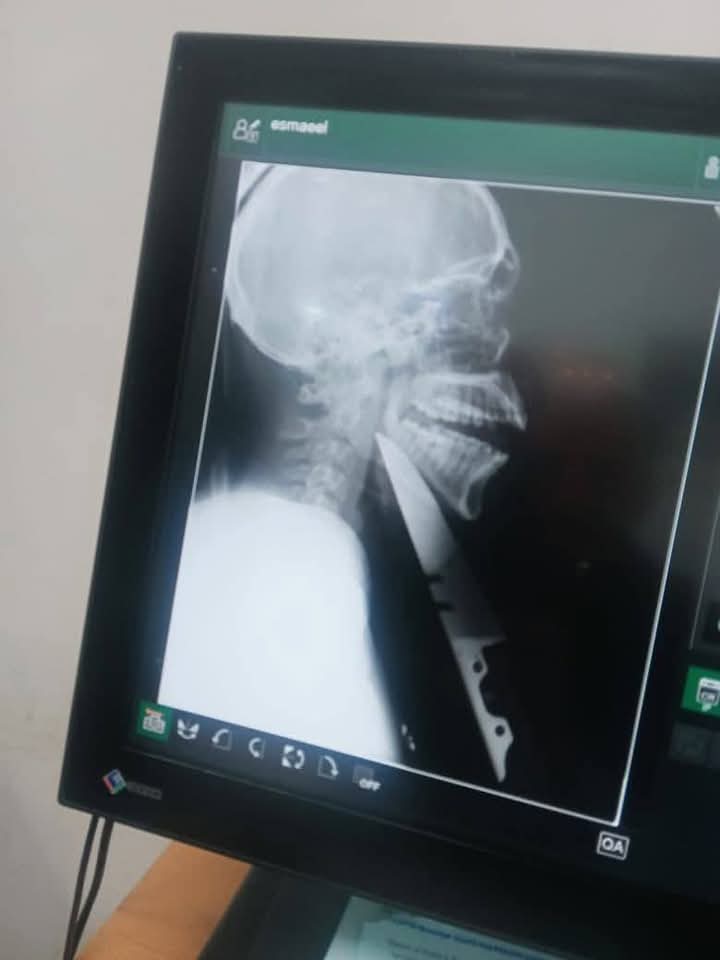 طعن سكين في الرقبة