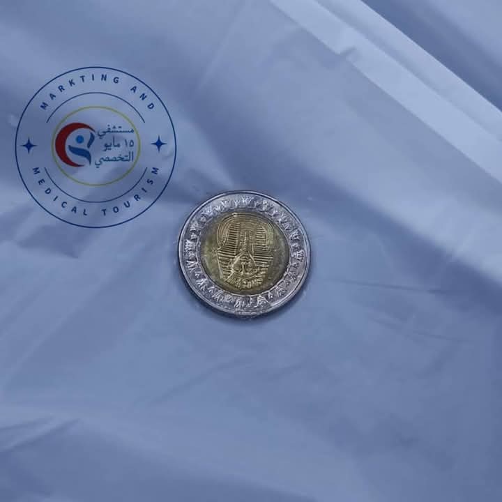 عملة معدنية من مريء طفلة 