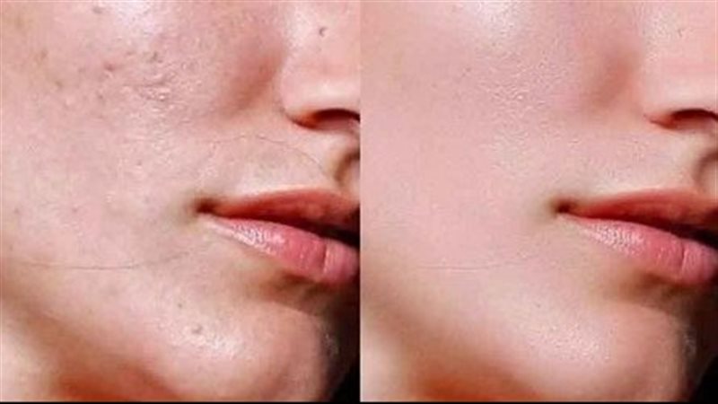 قناع طبيعي يخلصك من الكلف بالوجه 