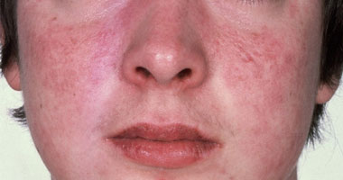 أعراض الذئبة الحمراء 