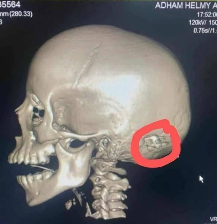 استقرار الطلقة النارية داخل جمجمة الطفل أدهم
