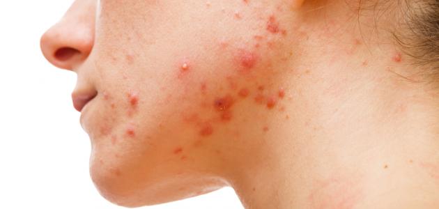 قناع الحلبة وماء الورد للتخلص من حب الشباب