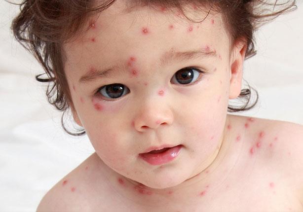 أعراض الجديري المائي