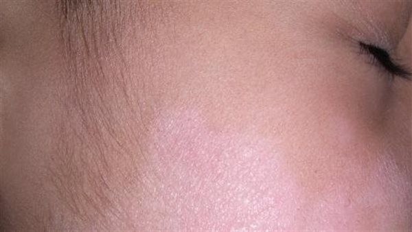 أسباب البقع البيضاء على وجه الطفل