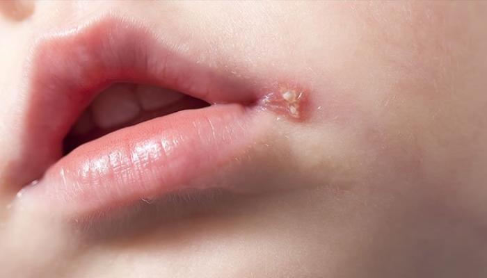 أعراض الهربس الفموى عند الأطفال 