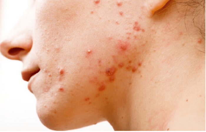 قناع الموز والعسل لعلاج حب الشباب 