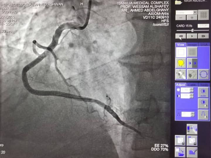 نجاح فريق قسطرة القلب بمجمع الإسماعيلية الطبي في إنهاء معاناة حالتين من أزمات قلبية خطيرة،فيتو