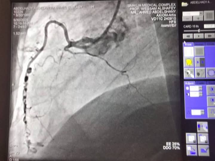 نجاح فريق قسطرة القلب بمجمع الإسماعيلية الطبي في إنهاء معاناة حالتين من أزمات قلبية خطيرة،فيتو