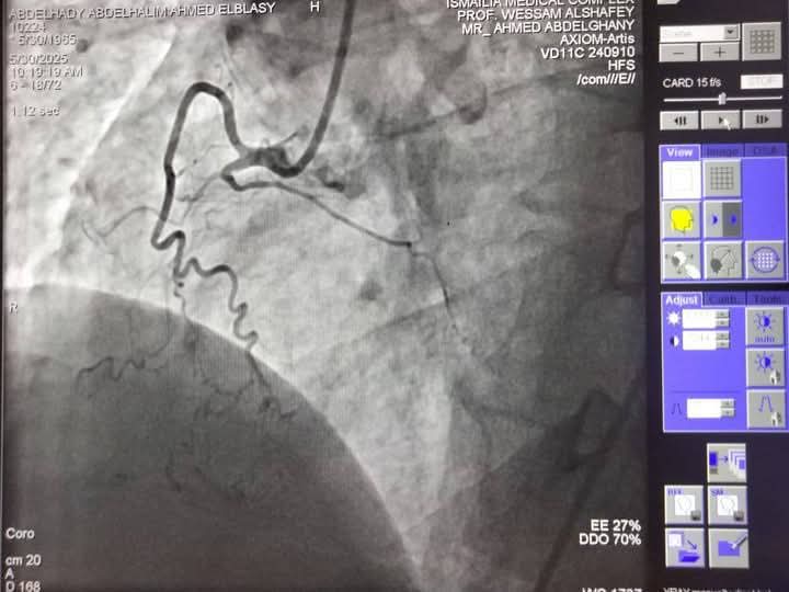 نجاح فريق قسطرة القلب بمجمع الإسماعيلية الطبي في إنهاء معاناة حالتين من أزمات قلبية خطيرة، فيتو