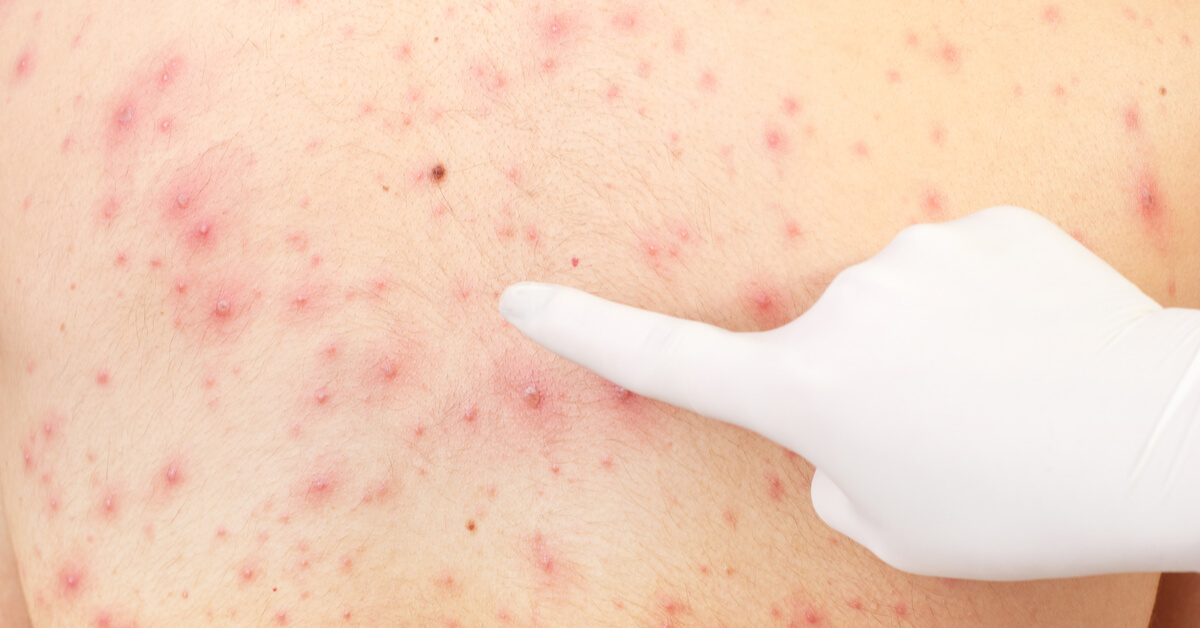 الحساسية والجديري المائى والهربس