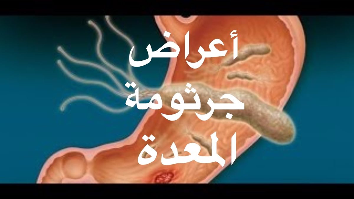 أعراض جرثومة المعدة