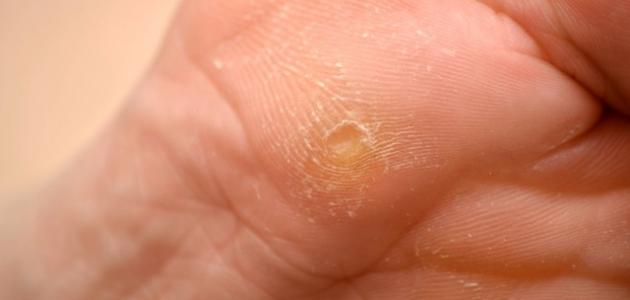 أعراض عين السمكة 