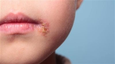 أعراض الهربس عند الأطفال