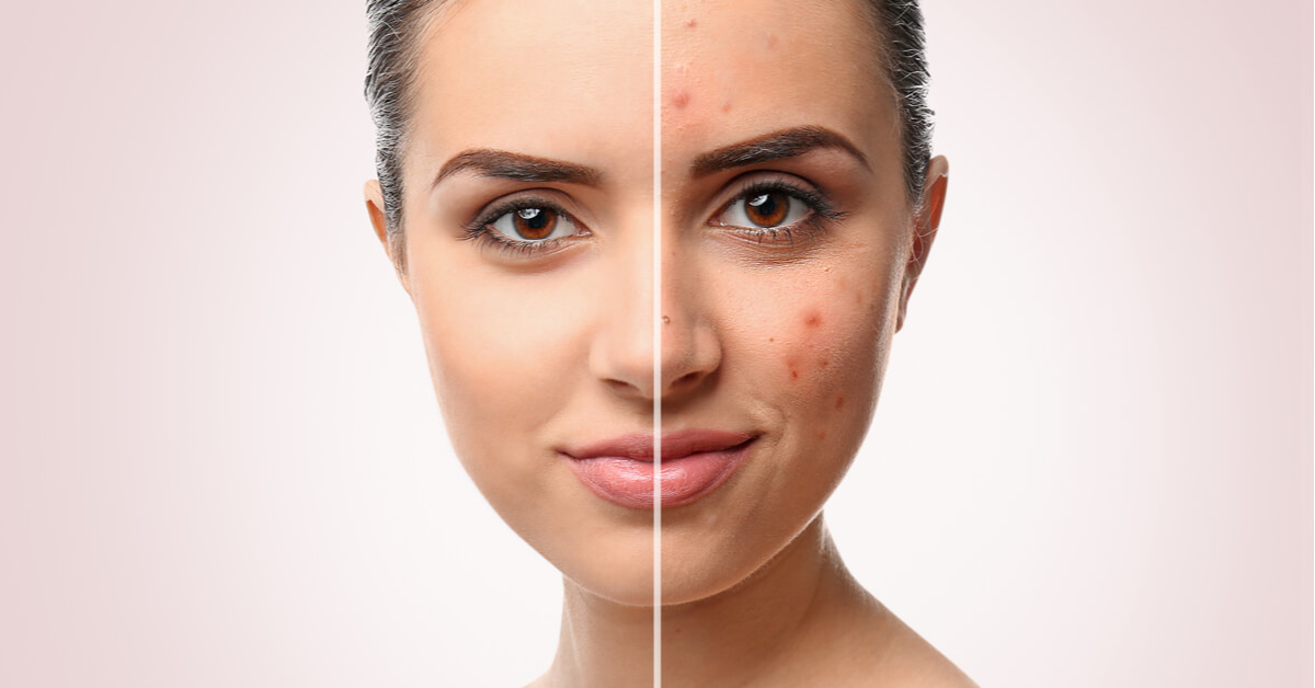 تخلصي من آثار حب الشباب بالبشرة 