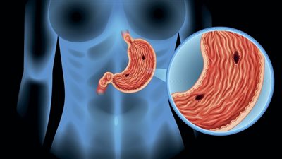 أعراض قرحة المعدة 