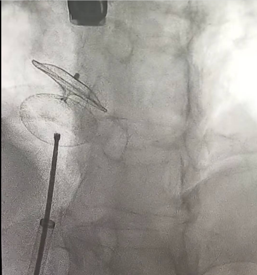 الثقب البيضاوي يهدد حياة الناس، فيتو