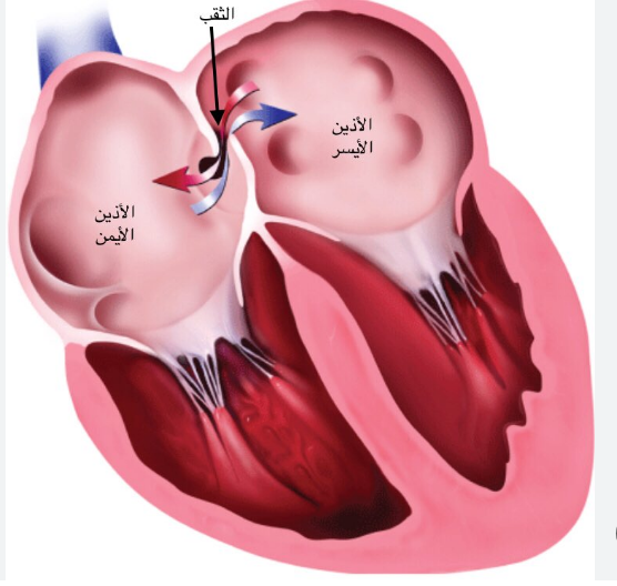 الثقب البيضاوي بين الأذنين  في القلب، فيتو