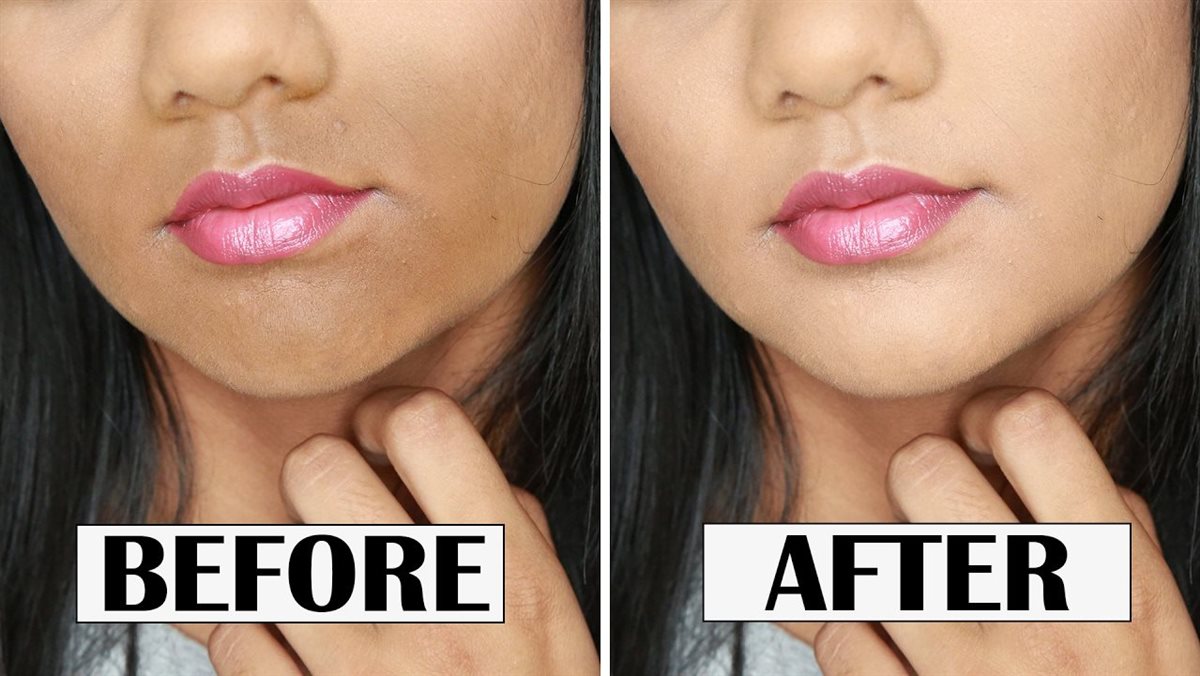 إزالة السواد حول الفم