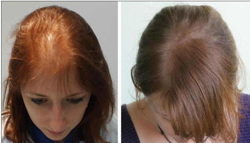 خلطة طبيعية لعلاج الشعر الخفيف والضعيف 