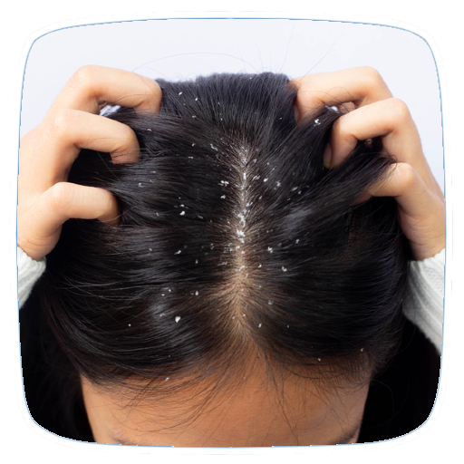 علاج قشرة الرأس